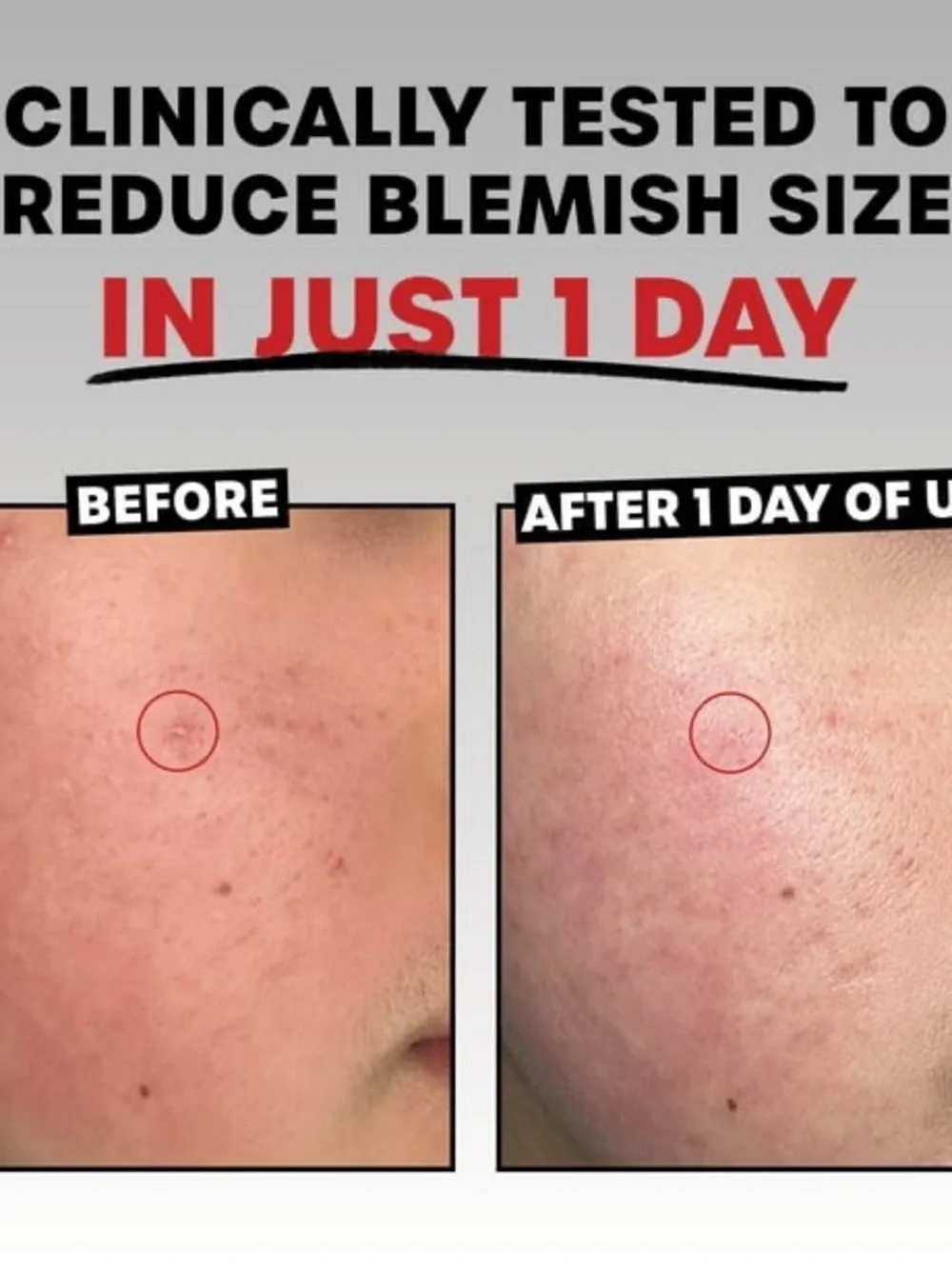 THAYERS Rapid Acne Treatment 10% Sulfur